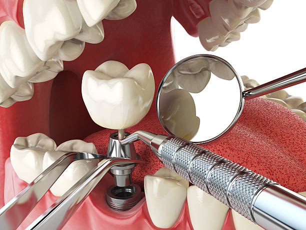 Best Emergency Tooth Extraction in Kuna, ID